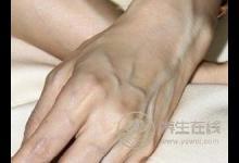 請問身上青筋多說明體內(nèi)寒濕重嗎