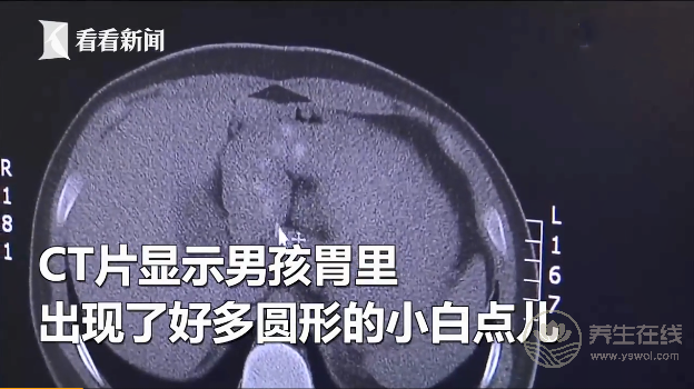 男孩因貪杯珍珠奶茶患上急性膽囊炎