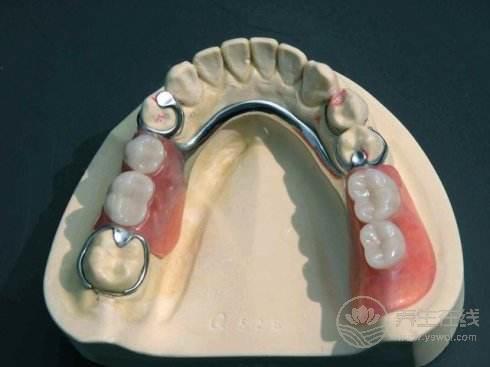 義齒有哪幾類，什么是義齒