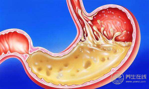 胃脹、胃酸、胃不舒服？簡單6招，還自己一個好胃