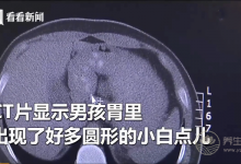 男孩因貪杯珍珠奶茶患上急性膽囊炎