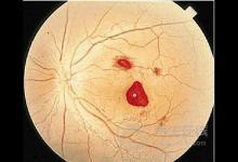 這兩類食物很毒，最容易導(dǎo)致肝癌，很多人還不注意