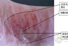 腳氣也是一種病，做到這一點能夠有效預防腳氣