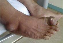 喝啤酒導致痛風嗎？喝酒為什么會痛風