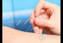 針灸減肥有效嗎針灸減肥有關的知識