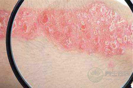 激素性皮炎不能吃什么?