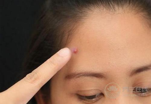 痘痘星人看過來，這3種食物咱別吃了，再好吃為了美也要忍