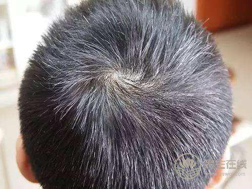 早生華發，試試枸杞，能幫你找回黑發