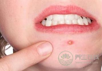 經期狂長痘痘怎么回事？排毒調理才是關鍵