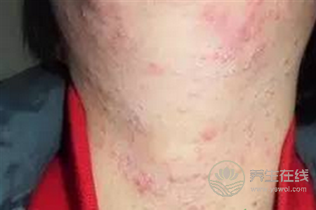 激素性皮炎不能吃什么?