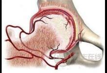 股骨頭壞死吃什么保養呢