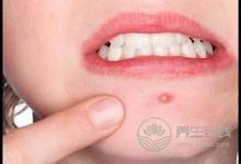 經(jīng)期狂長(zhǎng)痘痘怎么回事？排毒調(diào)理才是關(guān)鍵