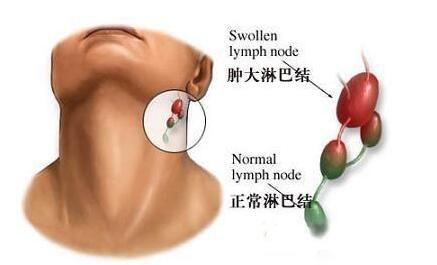 淋巴結排毒的方法以及定期排毒的好處