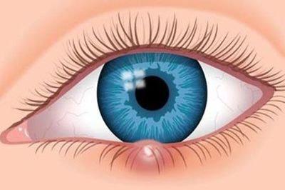 早期的麥粒腫應該采取哪些手段消除 早期的麥粒腫應該采取哪些手段消除