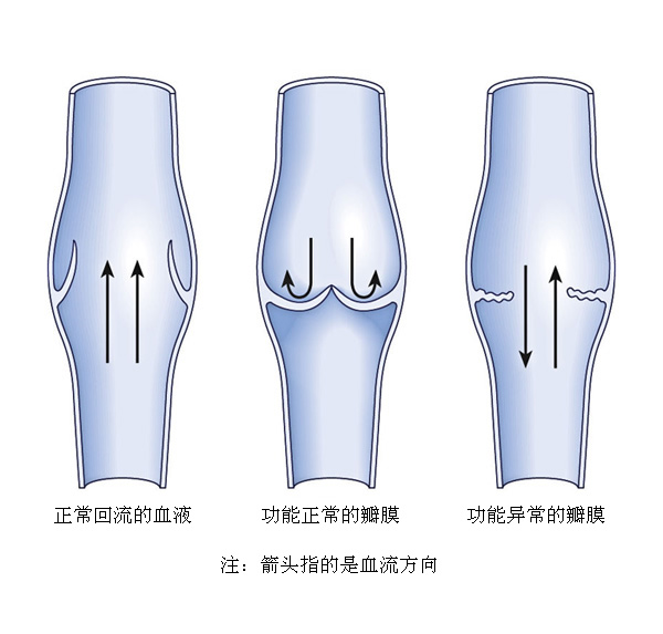 小腿靜脈曲張的治療方法如何治根