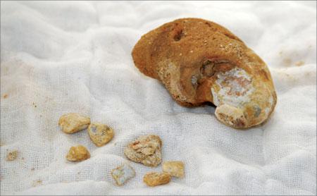 體內有結石的患者吃什么菜對身體最好