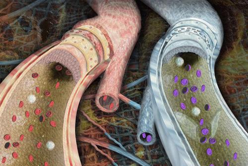 靜脈曲張患者應該如何合理進行運動 靜脈曲張患者應該如何合理進行運動