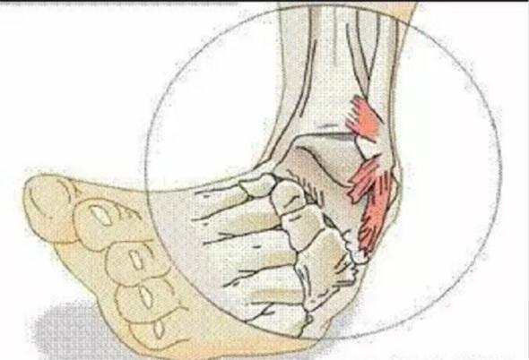 崴腳之后需要冷敷多長時間進行緩解