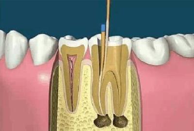 殺牙神經對于身體的好處與壞處有哪些