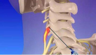 什么是神經(jīng)根損傷應(yīng)該如何治療損傷