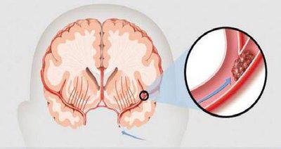 腦梗塞一旦出現應該如何按摩頭部