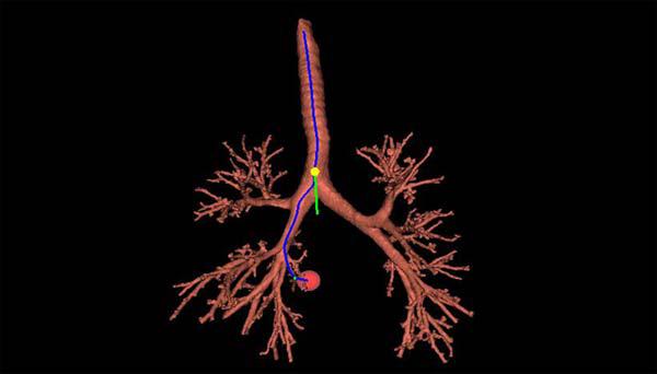 中醫有哪些治療支氣管炎的好方法