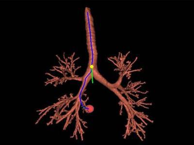 中醫有哪些治療支氣管炎的好方法