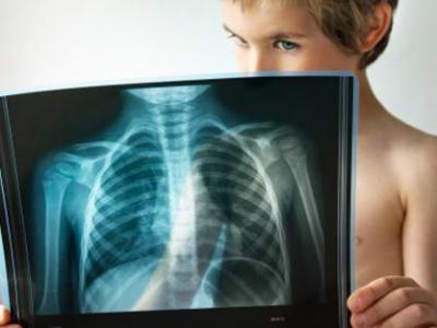 孕婦是否可以拍胸片會(huì)不會(huì)有輻射