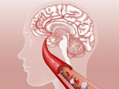 腦血栓患者吃哪些種類藥治療效果好