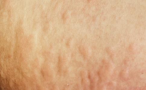 全身性濕疹出現(xiàn)的原因以及如何根治-易網(wǎng)健康<a href=http://m.henggaotouzi.com/jkys/ target=_blank class=infotextkey>養(yǎng)生</a>網(wǎng) 全身性濕疹出現(xiàn)的原因以及如何根治