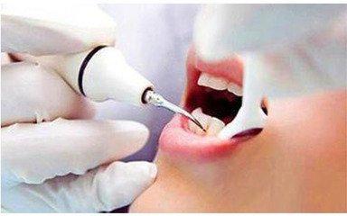 洗牙通常來說需要多長時(shí)間洗干凈