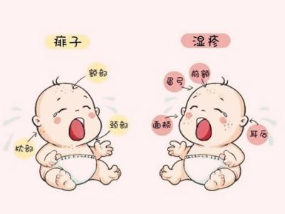 濕疹和蕁麻疹具體存在著哪些區(qū)別