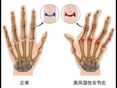 類風濕關節炎高發人群存在著哪些特性