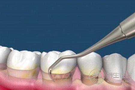 洗牙有什么好處?洗牙后注意事項(xiàng)有哪些?