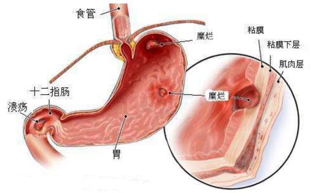 消化性潰瘍分為哪些不同的類型會(huì)有哪些表現(xiàn)-易網(wǎng)健康<a href=http://m.henggaotouzi.com/jkys/ target=_blank class=infotextkey>養(yǎng)生</a>網(wǎng) 消化性潰瘍分為哪些不同的類型會(huì)有哪些表現(xiàn)