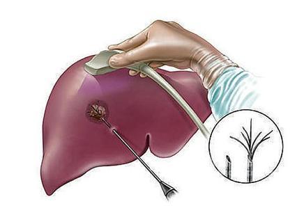 肝臟功能檢查的結(jié)果正確的解讀方法-易網(wǎng)健康<a href=http://m.henggaotouzi.com/jkys/ target=_blank class=infotextkey>養(yǎng)生</a>網(wǎng) 肝臟功能檢查的結(jié)果正確的解讀方法