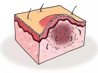 毛囊炎反復發作需要如何改善及解決
