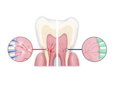 做好這六件事可以很好的預(yù)防牙齒敏感