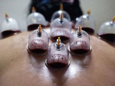 為什么拔罐之后會出現黑色水泡和血泡