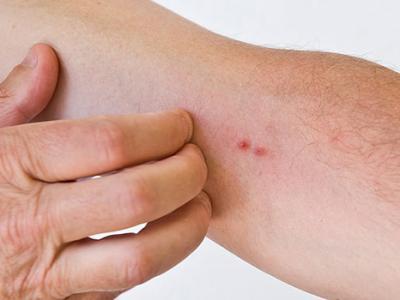 皮膚瘙癢的原因止癢的西藥有哪些