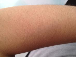 日光性皮炎患者可以正常參加軍訓嗎-易網健康<a href=http://m.henggaotouzi.com/jkys/ target=_blank class=infotextkey>養生</a>網 日光性皮炎患者可以正常參加軍訓嗎