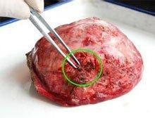 肝上有結節嚴重嗎肝結節一定是肝癌嗎