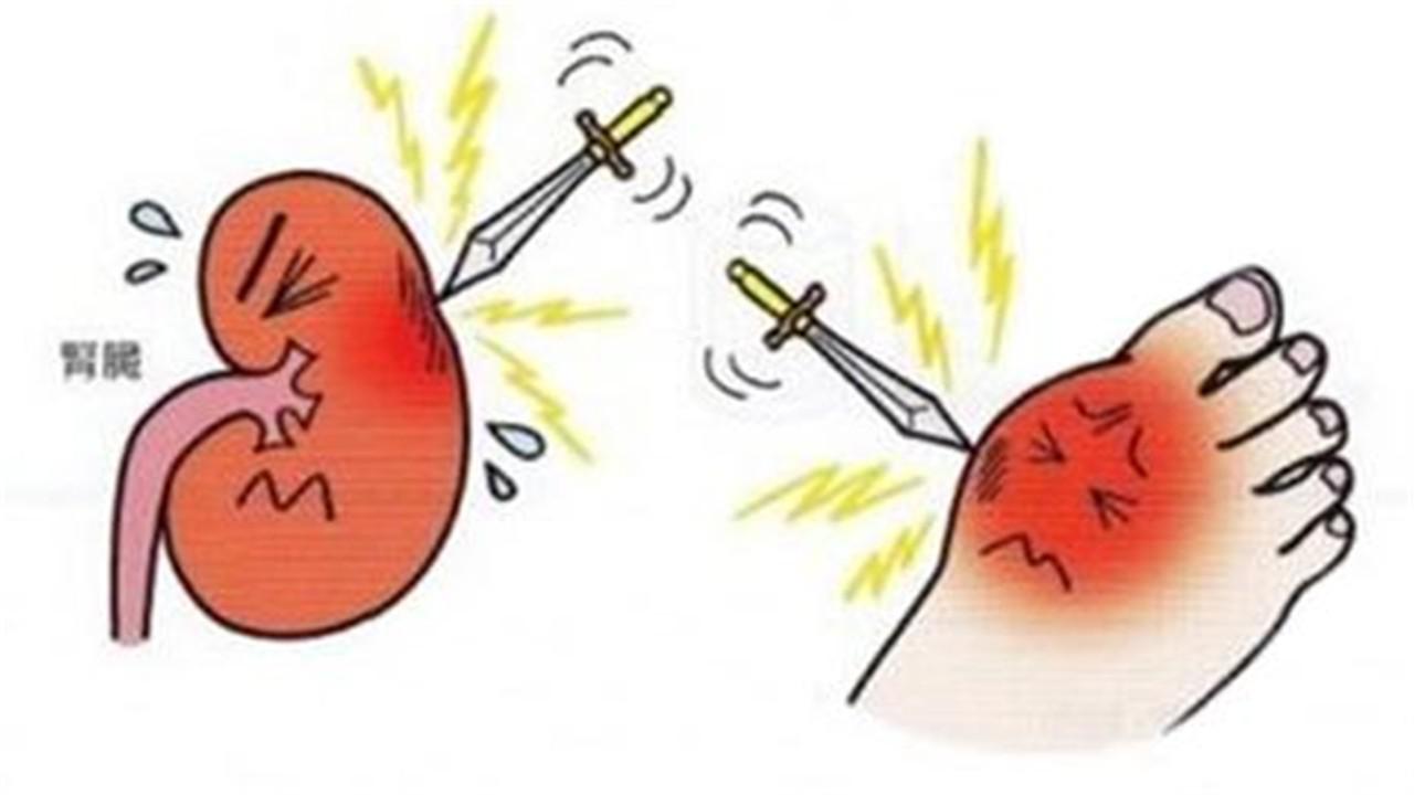 尿酸高不用慌遠離這三件事輕松排尿酸