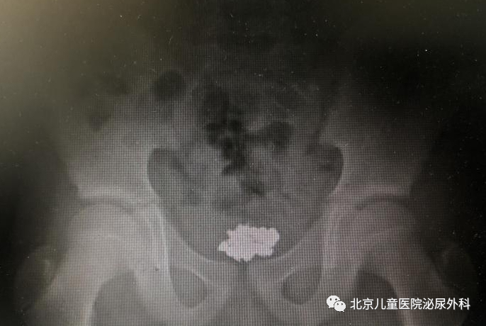 大夫，寶寶把東西塞進(jìn)下面了！怎么辦？