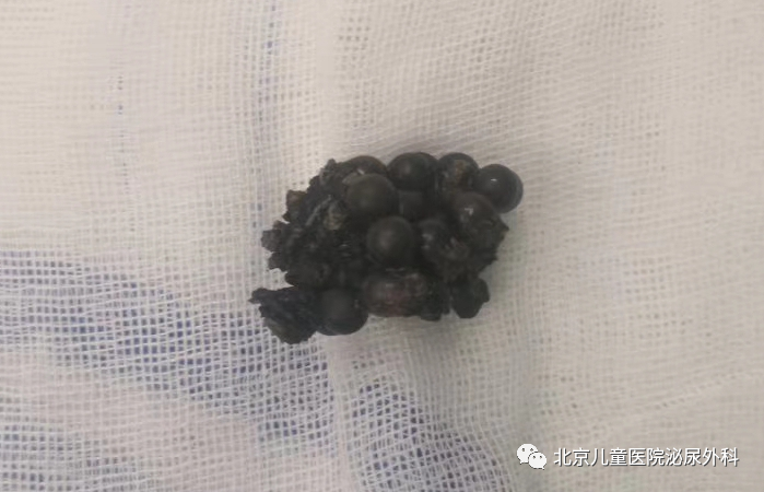 大夫，寶寶把東西塞進(jìn)下面了！怎么辦？