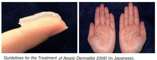 患特應性皮炎的人，如何“迎戰”秋燥？