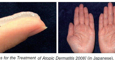 患特應性皮炎的人，怎樣“應戰”秋燥？