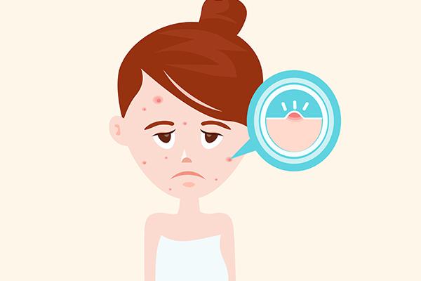 額頭長痘痘是什么緣故