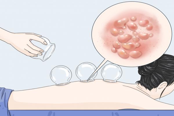 三伏天刮痧拔罐的好處和壞處 拔罐和刮痧哪個去濕氣