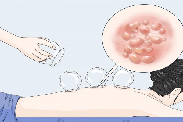 三伏天中午可以拔火罐嗎 三伏天拔罐的最佳時間